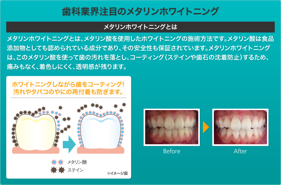 歯科業界注目のメタリンホワイトニング
