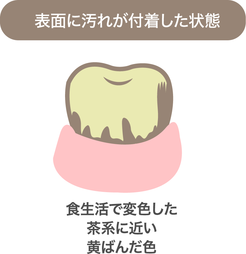 【表面に汚れが付着した状態】食生活で変色した茶系に近い黄ばんだ色