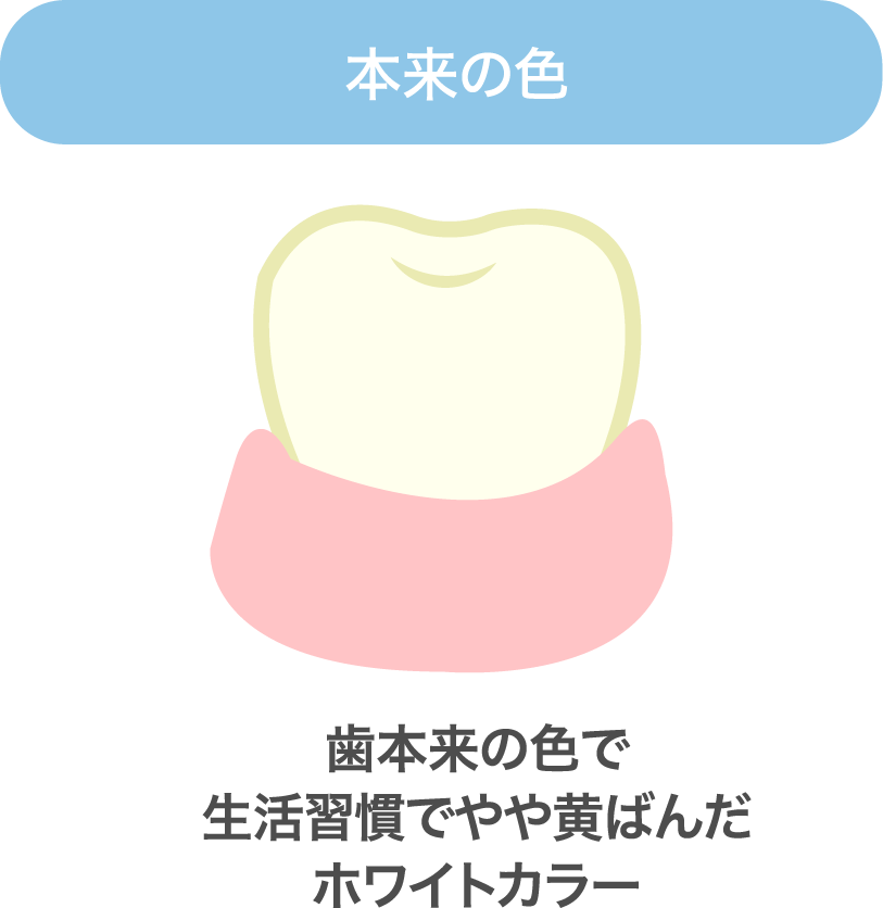 【本来の色】歯本来の色で生活習慣でやや黄ばんだホワイトカラー