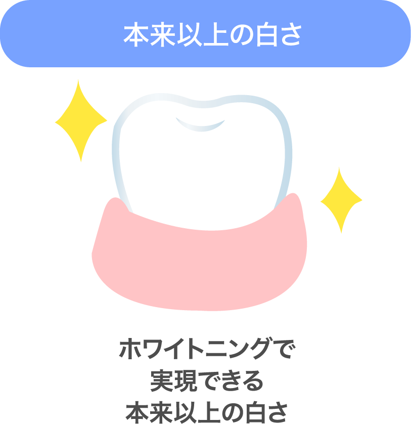 【本来以上の白さ】ホワイトニングで実現できる本来以上の白さ