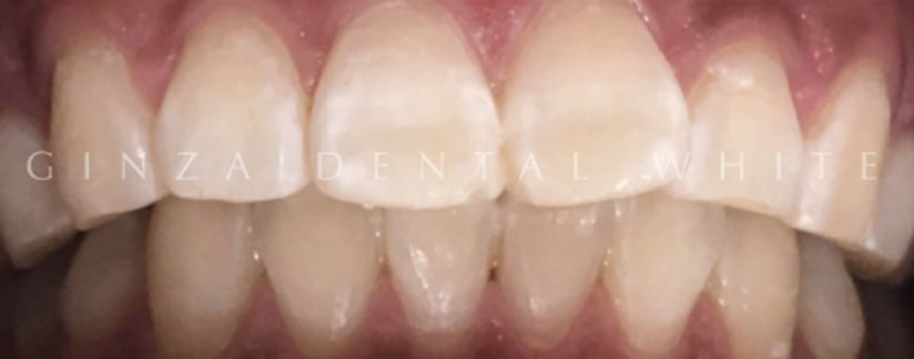 ミラクルホワイトニング施術後