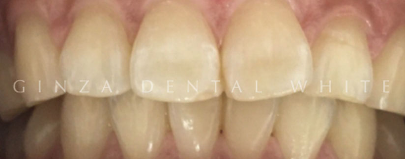 ミラクルホワイトニング施術前